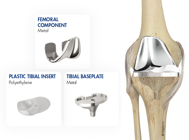 The femoral component, plastic tibial insert, and tibial baseplate of a knee replacement