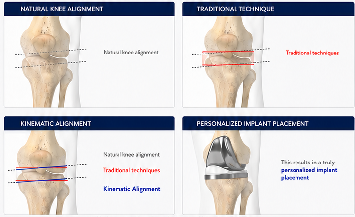 Diagram comparing natural knee alignment, traditional alignment, kinematic alignment, and personalized implant placement