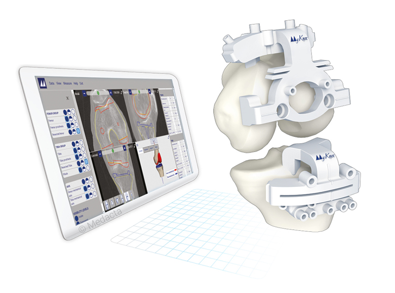 MyKnee digital planning screen and patient-matched surgical guides